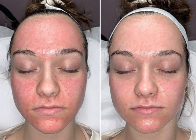 Two side-by-side facial photos: left shows red skin, right shows reduced redness after treatment.