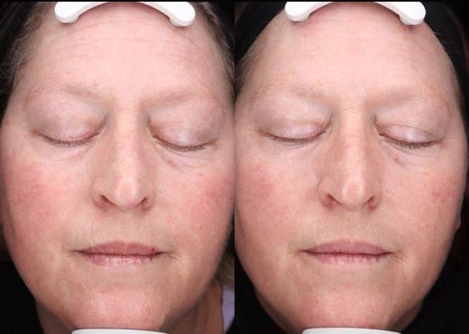 Side-by-side face of person with closed eyes; before and after skincare treatment, with reduced redness.
