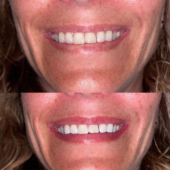Comparison of a smile before and after, showing whiter teeth and fuller lips.