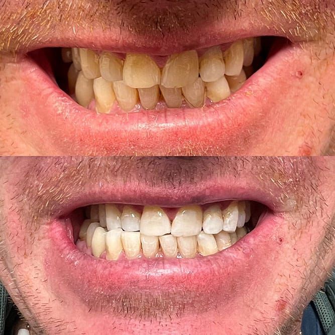 Comparison of teeth before and after whitening. Yellow teeth turn white after treatment.