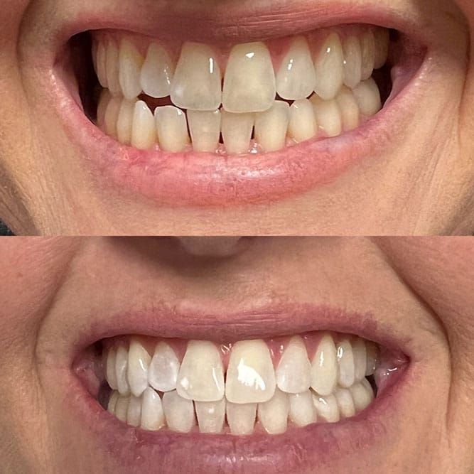 Side-by-side comparison of teeth, before and after whitening treatment; upper teeth show discoloration.