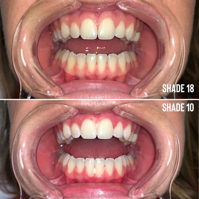 Side-by-side comparison of teeth shades. Top row: shade 18. Bottom row: shade 10. Both rows show an open mouth with dental instruments.