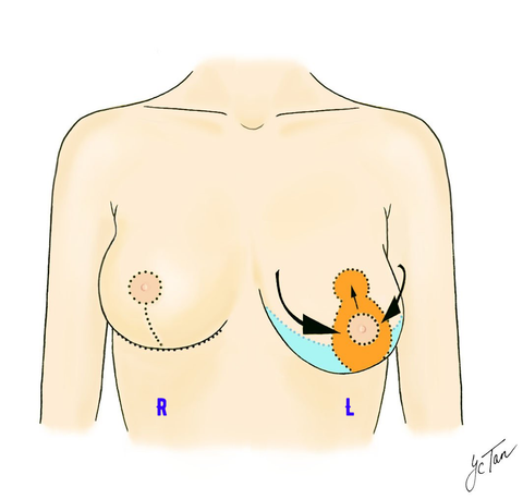 Breast Lift Mastopexy