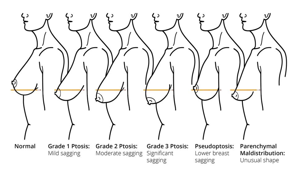 Sagging Breasts: Ptosis Of Breasts