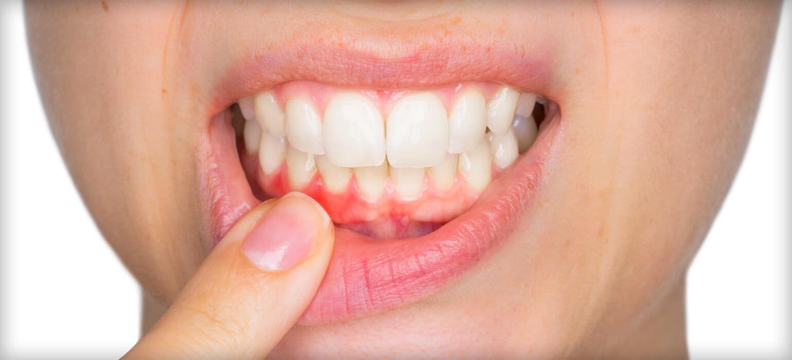 A person's mouth, showing inflamed gums. A finger points to the red, swollen area.