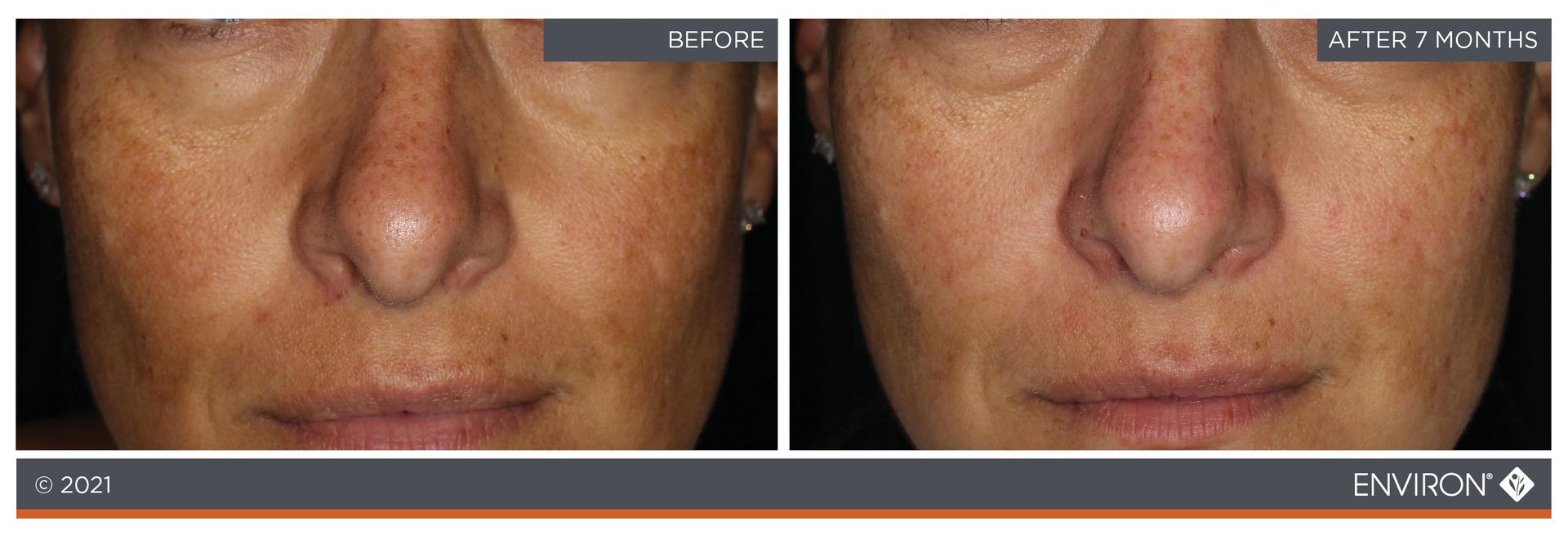 Side-by-side facial comparison: Before (left) shows dark spots; After (right) shows reduced spots, clearer skin.