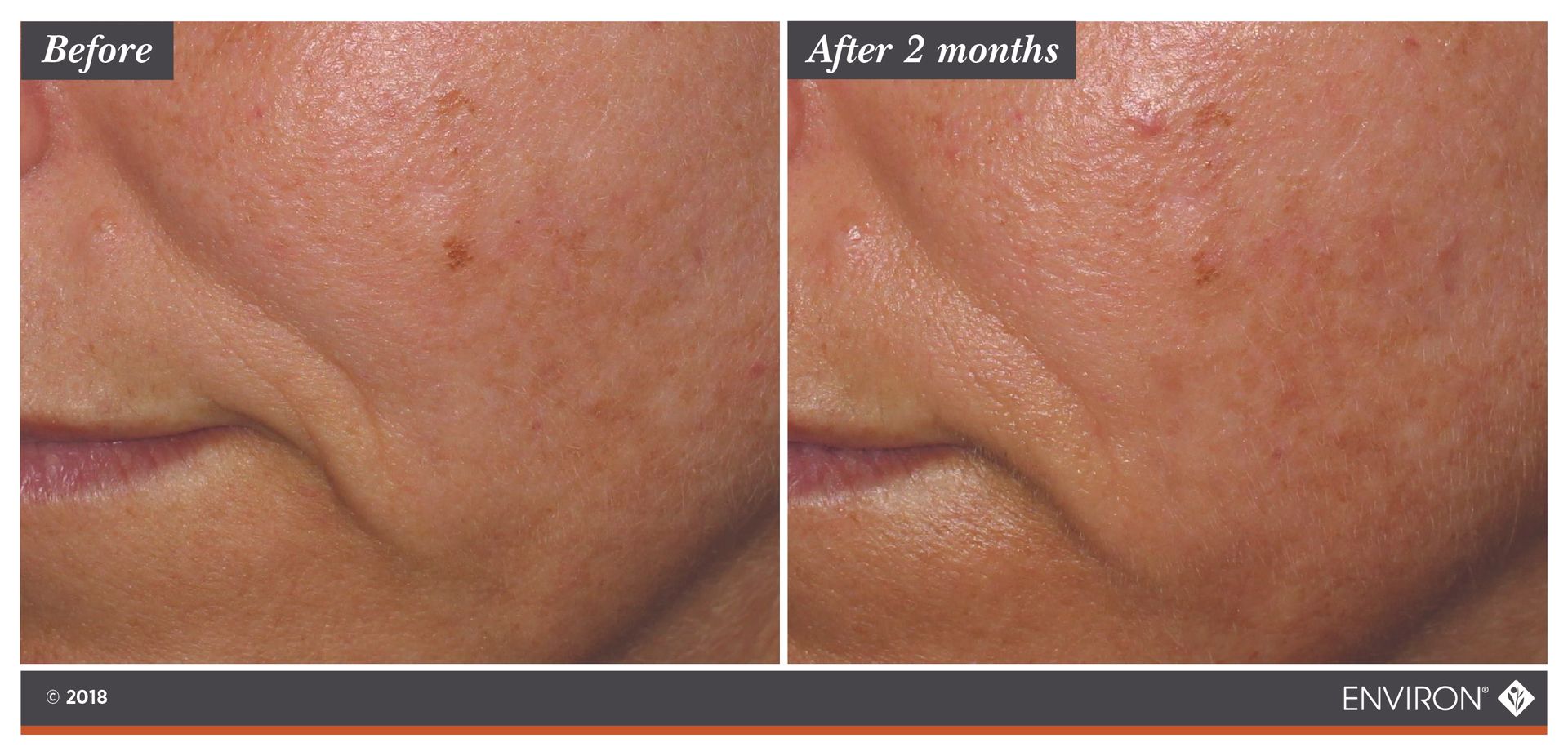 Before and after photo of a person's face, showing reduction in wrinkles after two months of treatment.