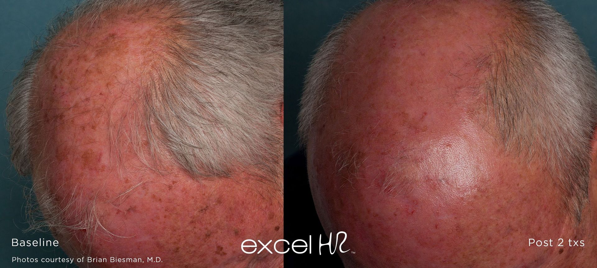 Comparison of two scalp views, before and after treatment for hair loss, showing improvement in hair density.