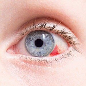 Ophthalmologist — Pale Blue Eye With Red Spot in Georgia, VT