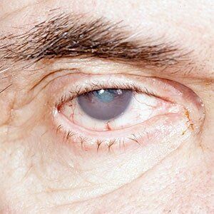 Pupillary Margin — Eye With Cataracts in Georgia, VT