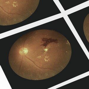 Retinopathy — Medical Photo Of Retinal Of A Diabetic Person in Georgia, VT