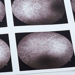 Eye Angiogram — Medical Print Of An Eye With Macular Degeneration