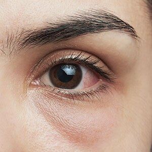 Eye Test — Woman With Swollen Slightly Red Eye in Georgia, VT