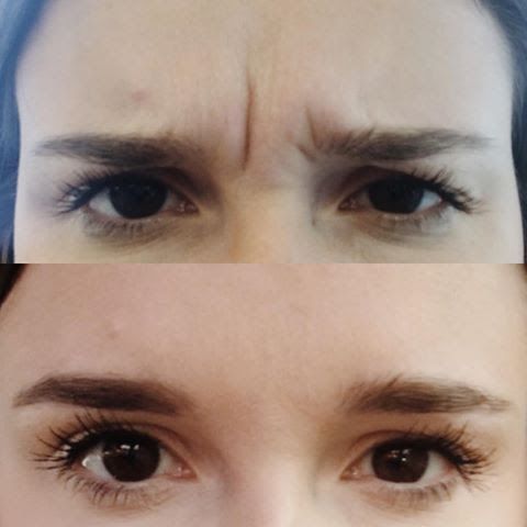 A before and after picture of a woman 's forehead botox treatment