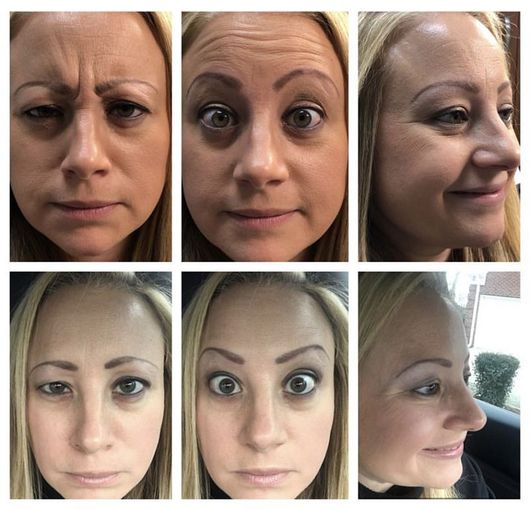 Before and after photos of a woman's face, showing wrinkles and expressions.