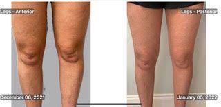A before and after photo of a person 's legs