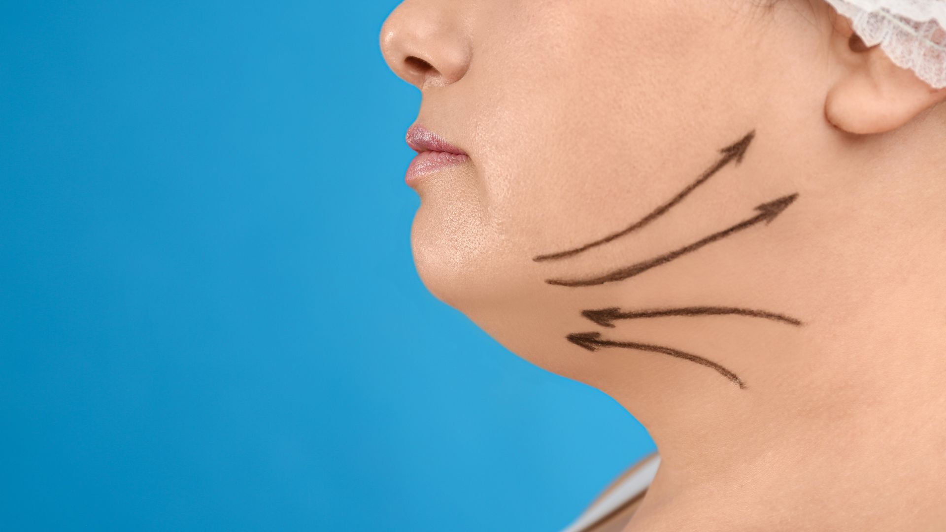 Kybella treatments in Grayson offer a non-surgical solution to reduce submental fat (double chin) for a defined jawline without the downtime of surgery.