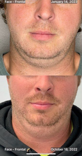 A before and after picture of a man 's face