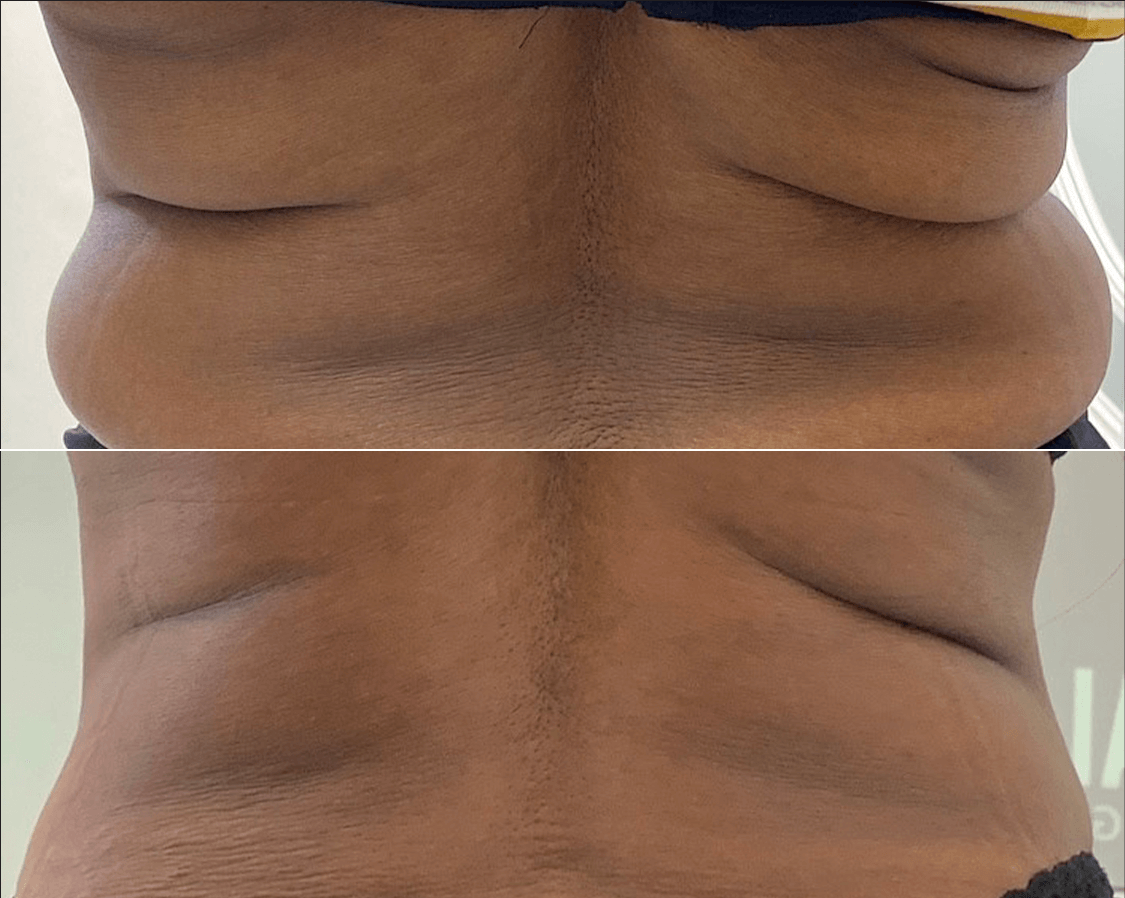 A before and after picture of a woman 's back.