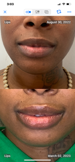 A before and after photo of a woman's lips. Fillers