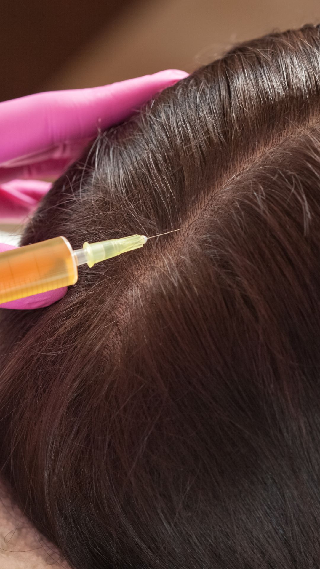 A woman is getting an injection in her hair. PRP Hair Restoration