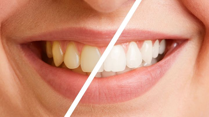 A before and after photo of a woman's teeth. Teeth Whitening