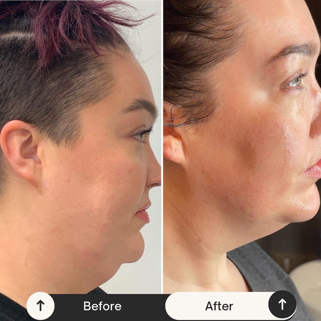 Side-by-side photos: before and after cosmetic procedure showing reduced double chin, lighter skin tone.