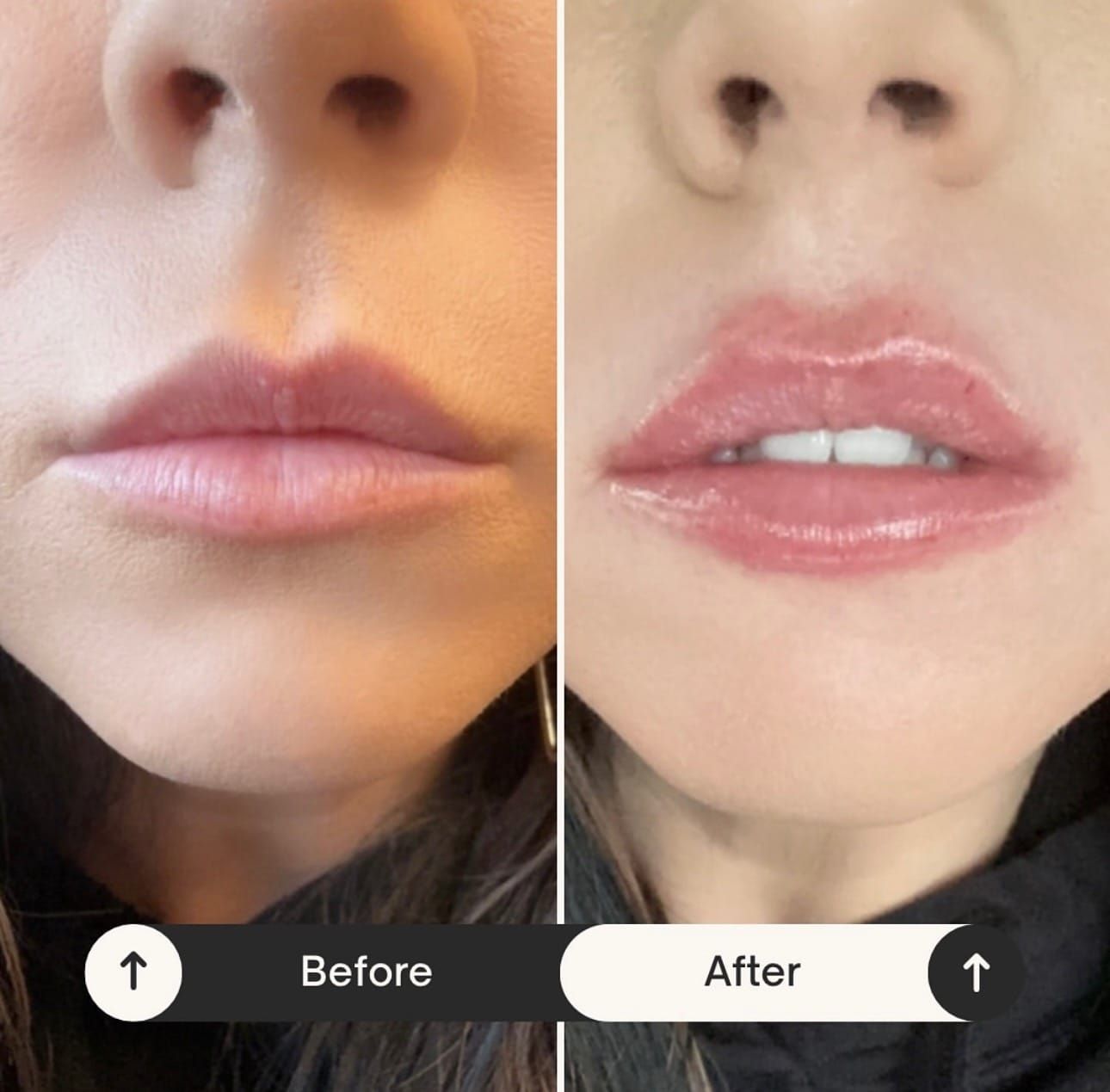 Side-by-side photo: Before and after lip filler injections.  Fuller lips in the