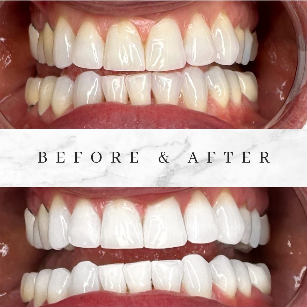 Before and after of teeth whitening: yellow teeth turn bright white, with healthy gums visible.