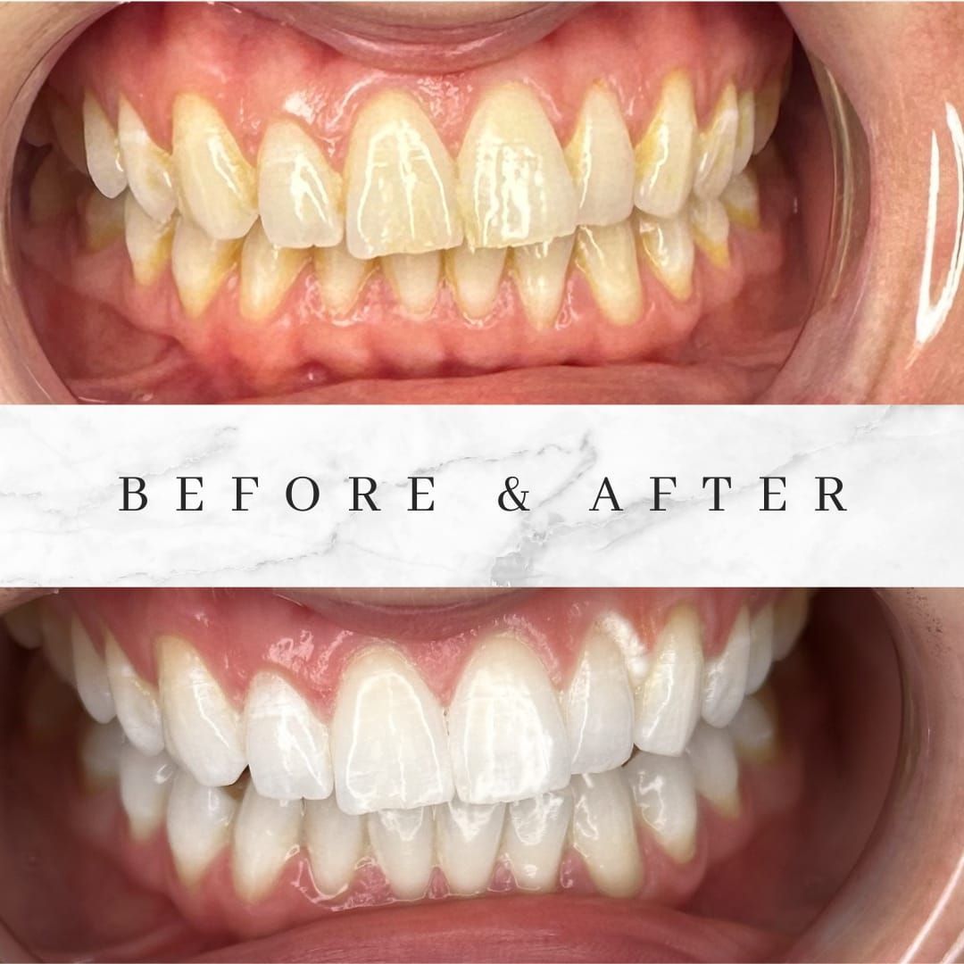 Before and after comparison of teeth whitening; top shows yellow teeth, bottom shows bright white teeth.