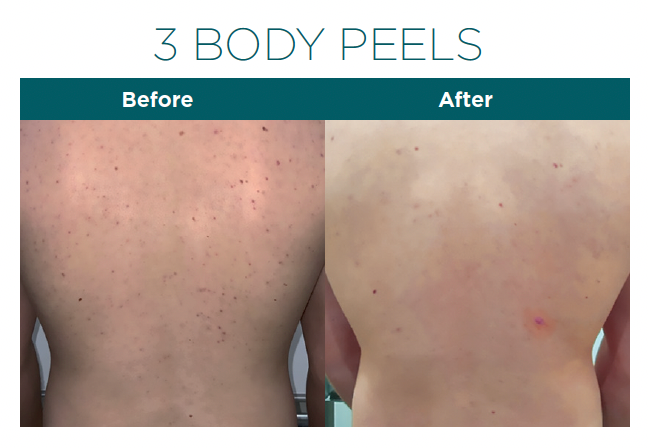 Our Back Peels involve the application of a chemical solution to peel away the top layers of skin, revealing smoother, clearer skin underneath.