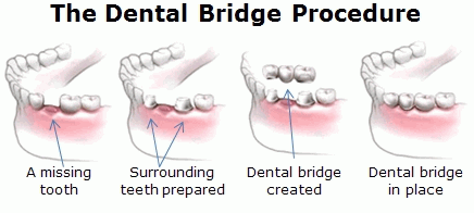 Dental Bridge Procedure — Kingston, NY — Joseph Diacovo, DMD