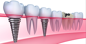 Dental Implants — Kingston, NY — Joseph Diacovo, DMD