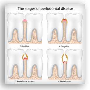 Gum Disease — Kingston, NY — Joseph Diacovo, DMD