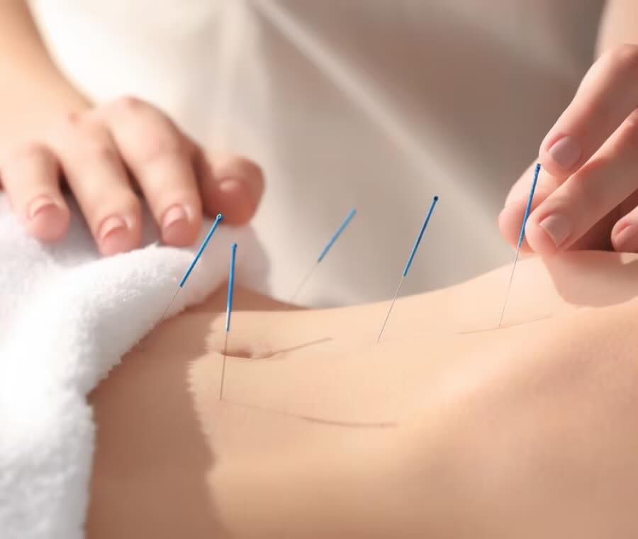 Un terapeuta inserisce aghi da agopuntura nell'addome di un paziente durante una seduta.