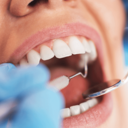 Estetinis dantų protezavimas ir plombavimas