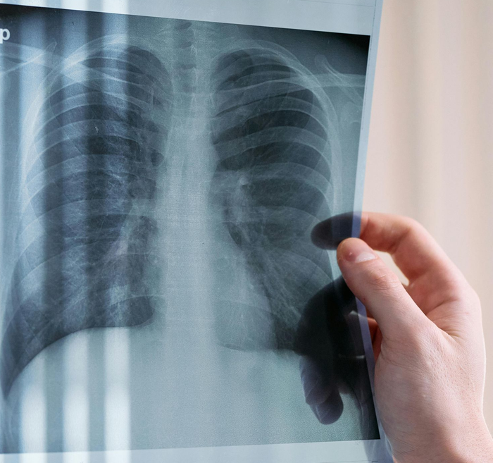 doctor holding an X-Ray of a patients lungs, showing some faint masses in the lungs through the chest.