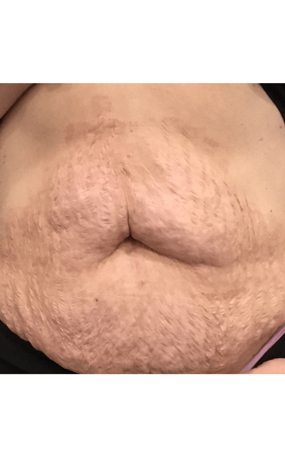 a close up of a woman 's stomach with stretch marks 