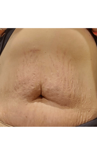 a close up of a woman 's stomach with stretch marks