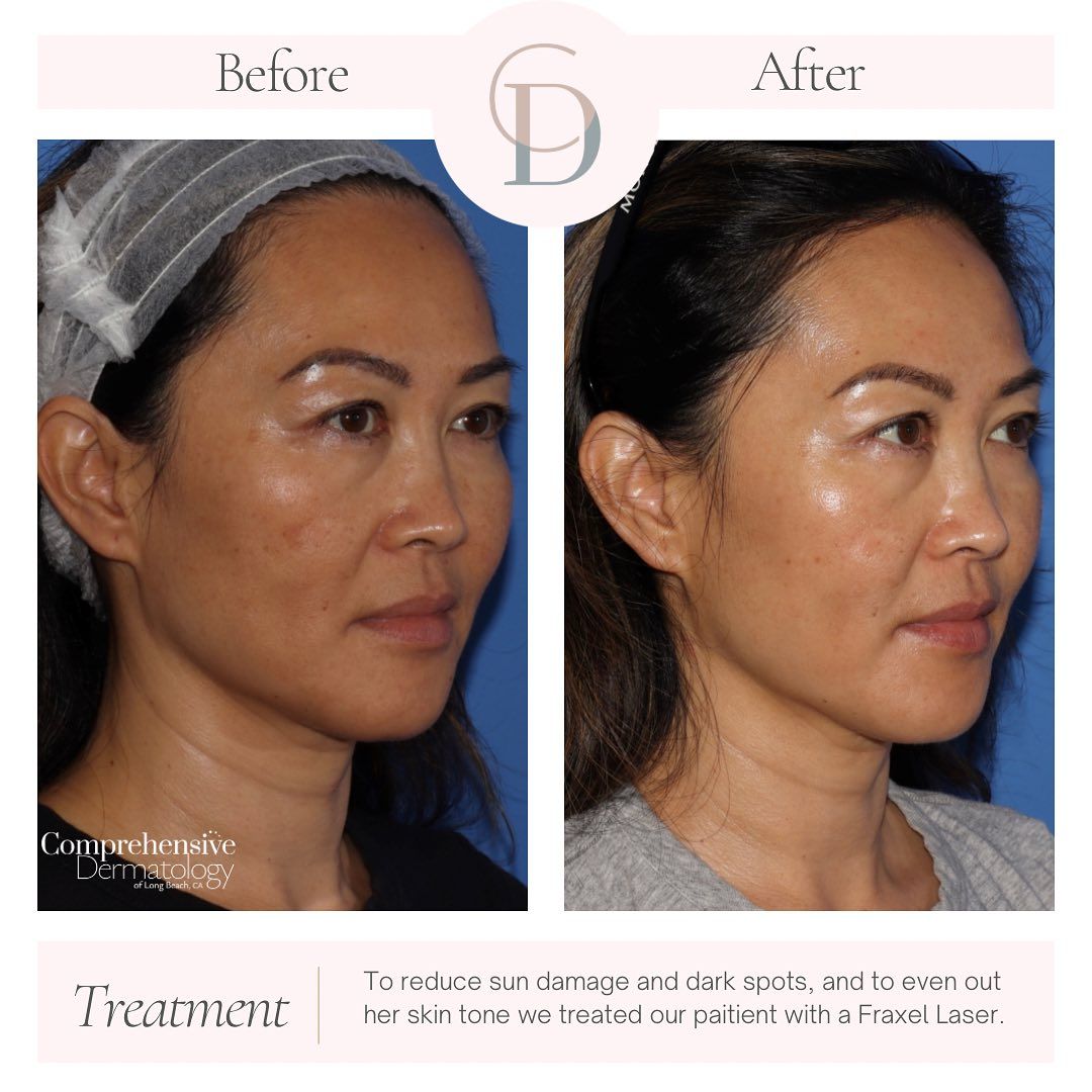 a before and after portrait of a woman's facing right after getting laser resurfacing treatment. her face is now smoother and has less wrinkles and glowing