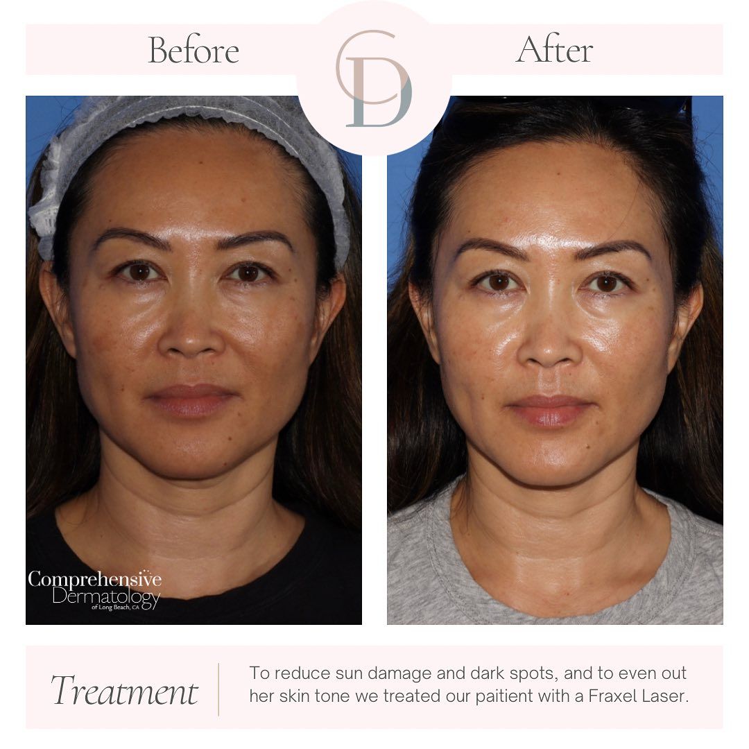 a before and after photo of a woman's entire face after getting laser resurfacing treatment. her face is now smoother and has less wrinkles and glowing