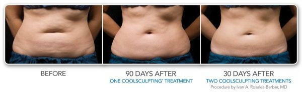 a woman 's stomach is shown before , 90 days after , and 30 days after a coolsculpting treatment .