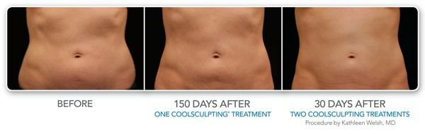 a woman 's stomach before and after a coolsculpting treatment .