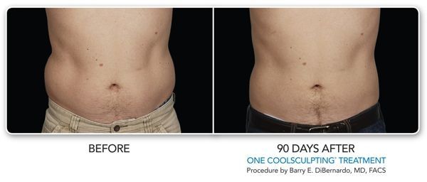a man 's stomach before and after a coolsculpting treatment .