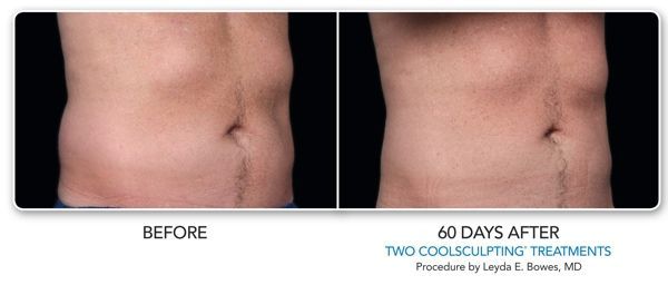 a before and after picture of a man 's stomach