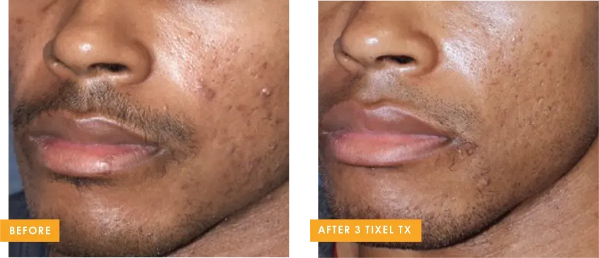 Side-by-side comparison: face with acne "before" versus "after 8 week" treatment, skin appears clearer in the right image.