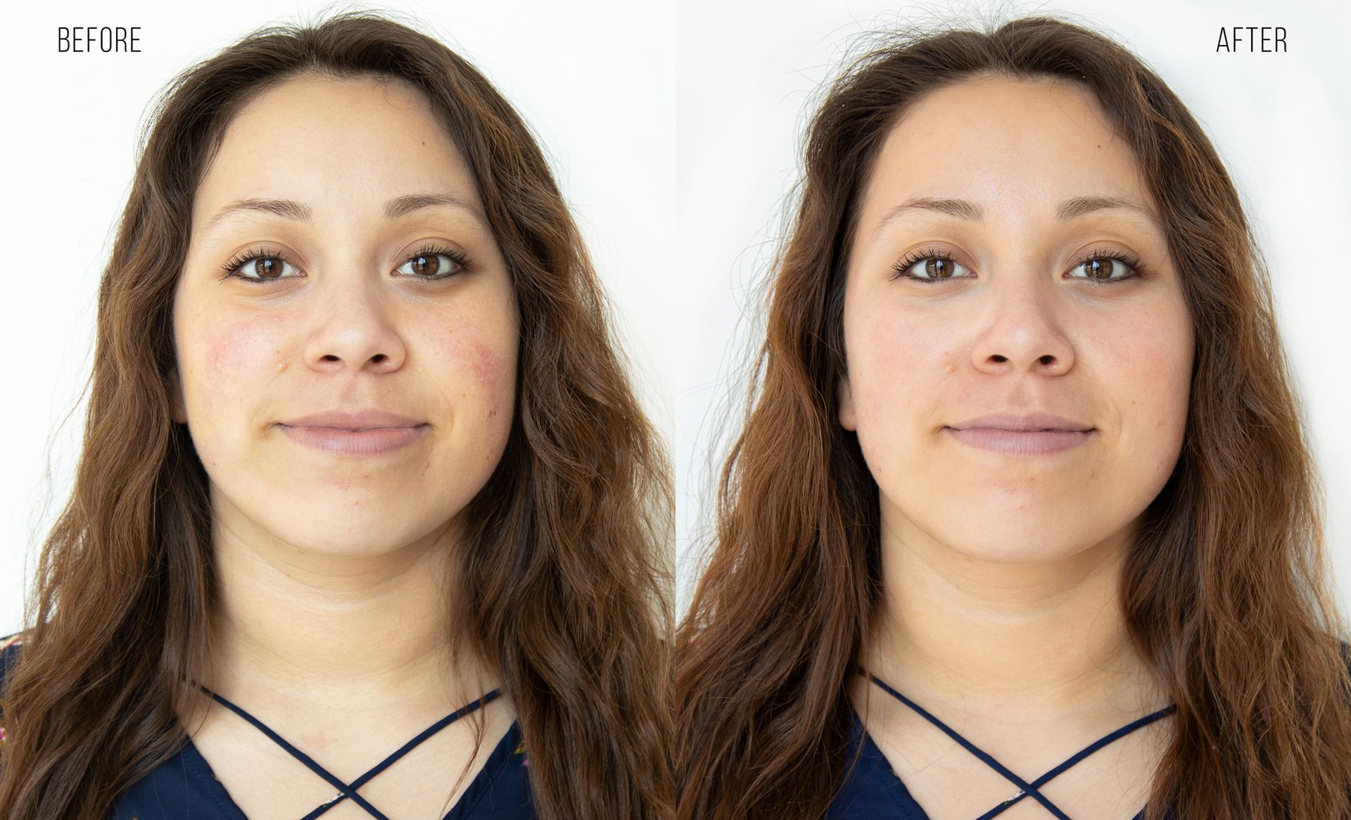 woman's face before and after treatment with Hydrafacial