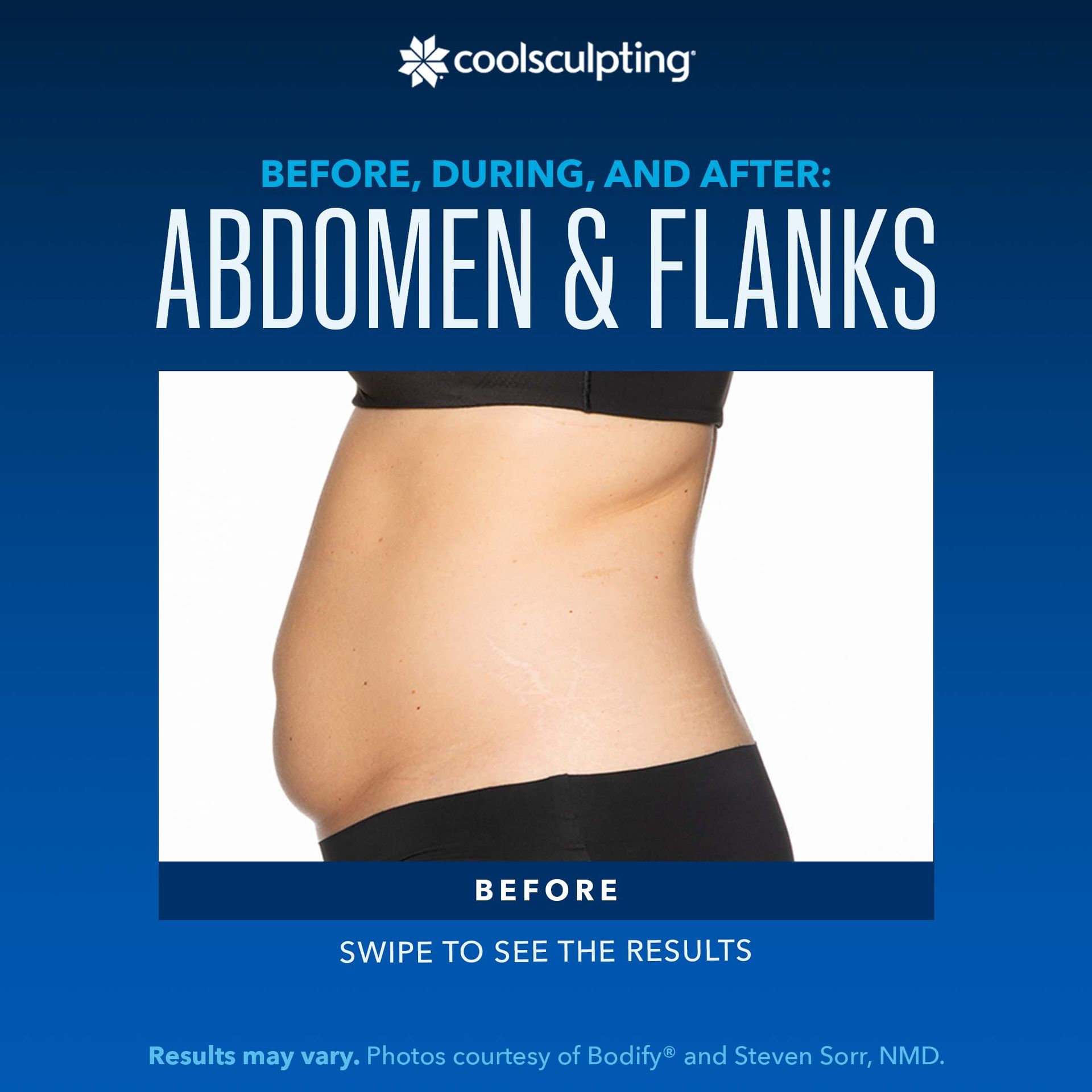a before picture of a woman's abdomen and flanks for coolsculpting treatment