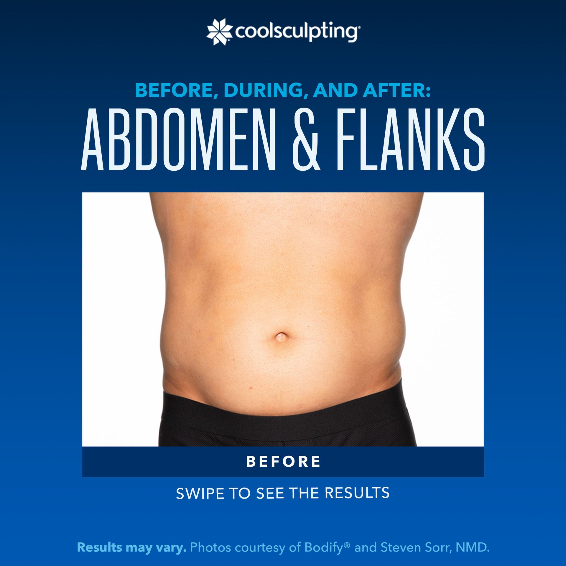 a before picture of a man's abdomen and flanks for coolsculpting treatment