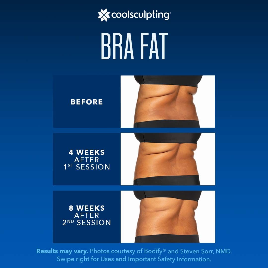 a woman's torso with bra fat is shown before and after a coolsculpting treatment